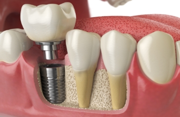 Dental implants & Surgery